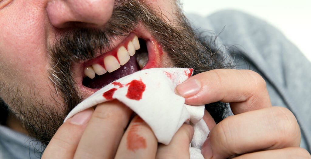 Vérző fogíny gyógyítható, nem kell a legrosszabra gondolni - Fogorvos válaszol