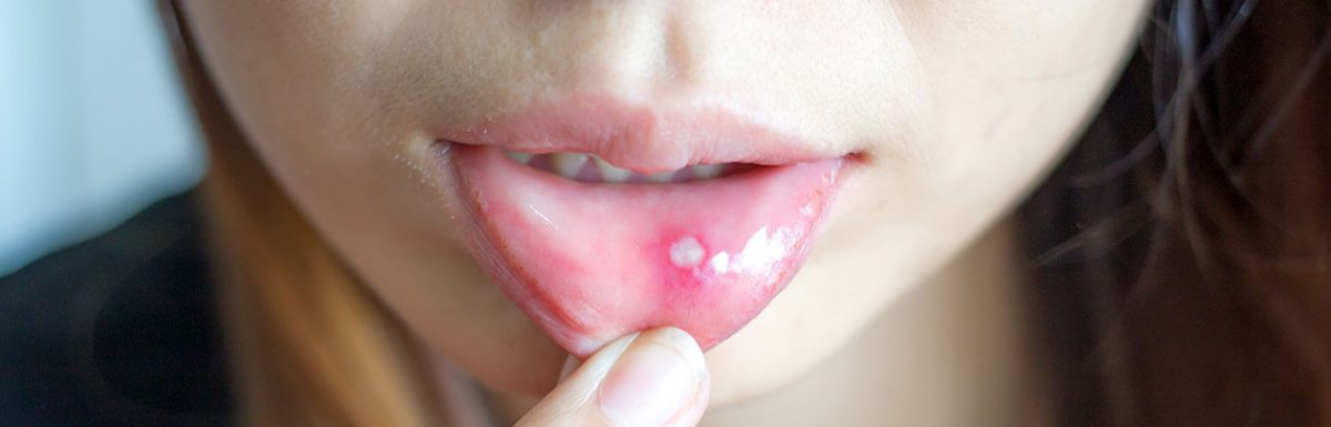seb a szájon belül cukorbetegség kezelésére skarlát