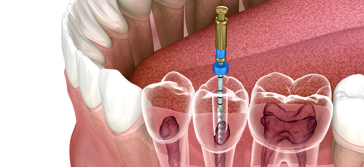 Visszanő az elsorvadt fogíny? Mik a fogínysorvadás tünetei? | parodontax